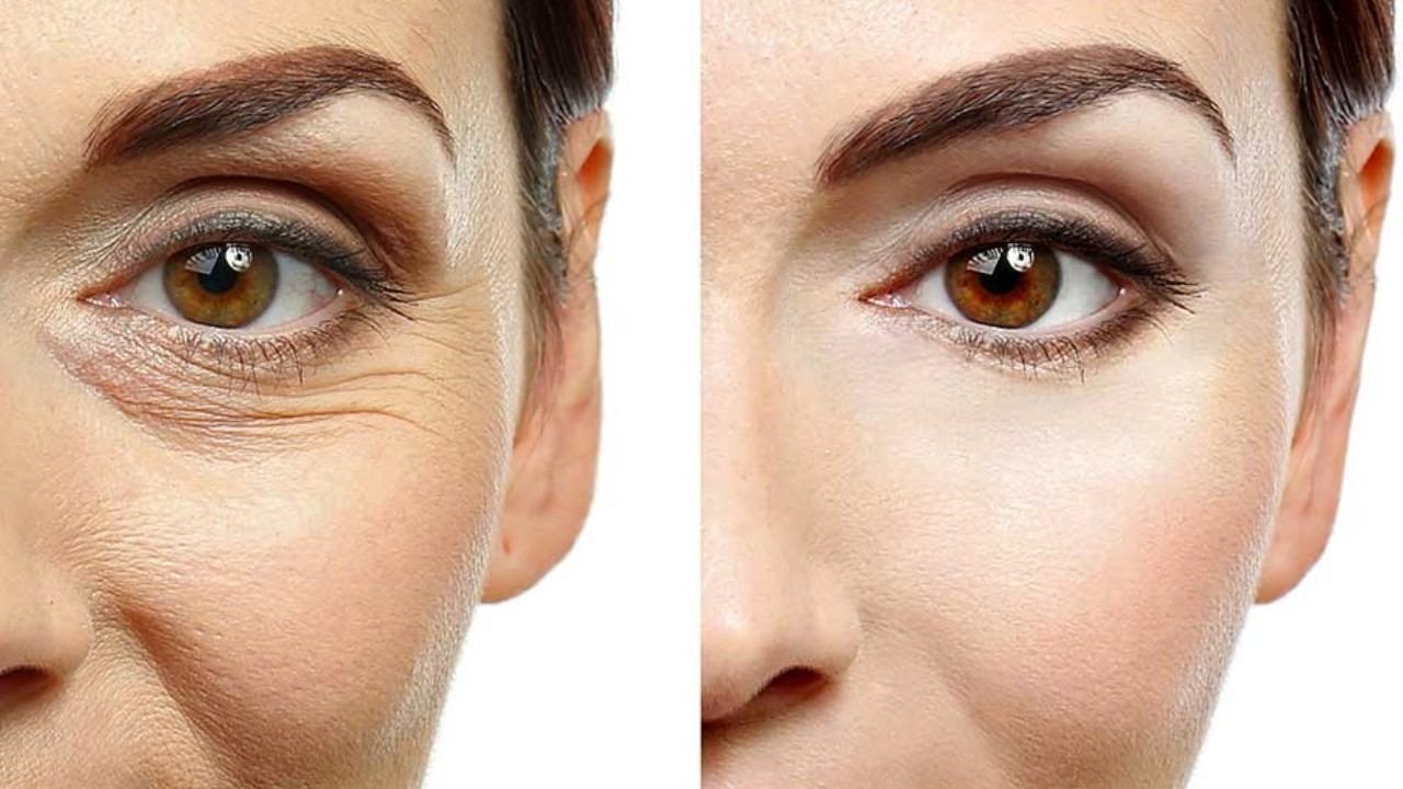 Ei voiteita, ei kotikonsteja: salaisuus ihon tasoittamiseen ja kasvojen ryppyjen vähentämiseen 40 vuoden jälkeen.