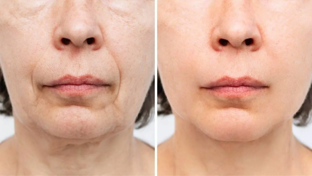 Ei voiteita, ei kotikonsteja: salaisuus ihon tasoittamiseen ja kasvojen ryppyjen vähentämiseen 40 vuoden jälkeen.